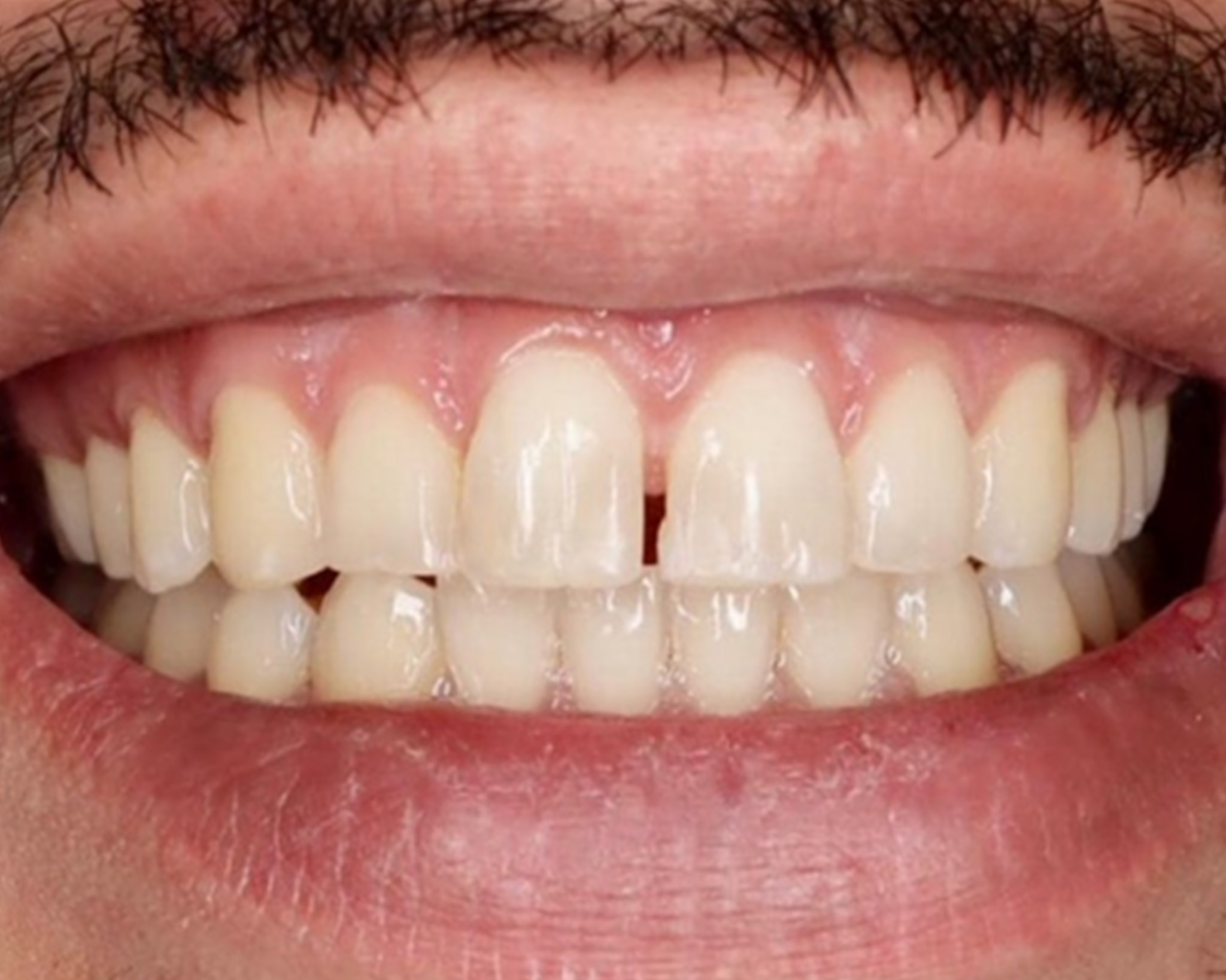 Lateral